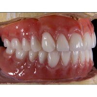 义齿加工 深圳假牙加工|烤瓷牙|隐形全口义齿|种植牙